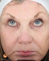Female treated with 3 Photodynamic Therapy with Levulan for Pre-Skin Cancer (AK's)