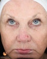 Female treated with 3 Photodynamic Therapy with Levulan for Pre-Skin Cancer (AK's)