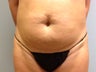 Tummy Tuck