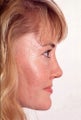 Rhinoplasty