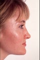 Rhinoplasty