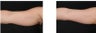 CoolSculpting non-invasively eliminates excess fat on the arms.