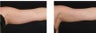 CoolSculpting non-invasively eliminates excess fat on the arms.