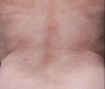 Female treated for Back Fat