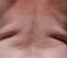 Female treated for Back Fat