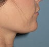 Chin Augmentation