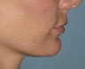 Chin Augmentation