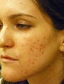 Acne Scars Laser Surgery