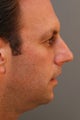 Male Chin Implant