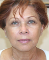 Mini Face Lift with Bilateral Brow Lift