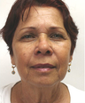 Mini Face Lift with Bilateral Brow Lift