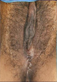 Vaginaplasty Before and After
