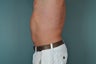 Liposuction