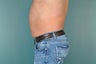 Liposuction