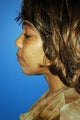 chin implant