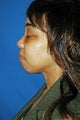 chin implant
