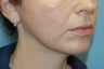 Mini Lifts are an excellent choice for younger patients looking to freshen up in a natural way