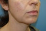 Mini Lifts are an excellent choice for younger patients looking to freshen up in a natural way