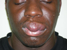 Male Facial Reconstructive Surgery