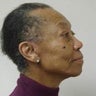 Neck Lift