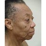 Neck Lift