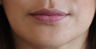 Lip Implant