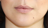 Lip Implant