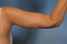 Arm Lift