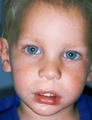 Cleft Lip Repair
