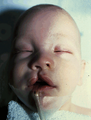 Cleft Lip Repair