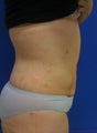 Laser Liposuction