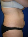 Laser Liposuction