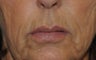 62 y/o female desired fuller lips with filler.