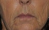 62 y/o female desired fuller lips with filler.
