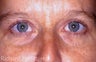 Upper Blepharoplasty to correct hooding