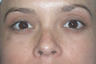 Latisse for Eyelashes