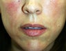 Juvederm in Nasolabial folds