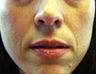 Juvederm in Nasolabial folds