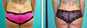 Liposuction Before & After