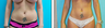 Liposuction Before & After