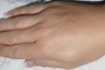 Laser Hair Removal