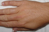Laser Hair Removal