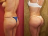 Buttock Augmentation with Fat Grafting or Brazilian Butt Lift- BBL
