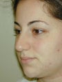 Middle-Eastern female desiring a softer but still ethnic nose