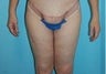 Bodylift with Extended Thigh Lift