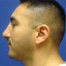 Chin Genioplasty & Rhinoplasty