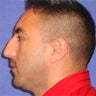 Chin Genioplasty & Rhinoplasty