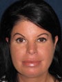 42 year old female for Lip Enhancement