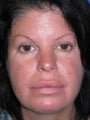 42 year old female for Lip Enhancement