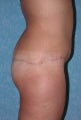 Buttock Augmentation with Circumferential Body Lift